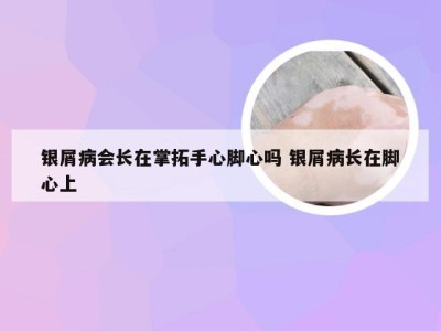 银屑病会长在掌拓手心脚心吗 银屑病长在脚心上