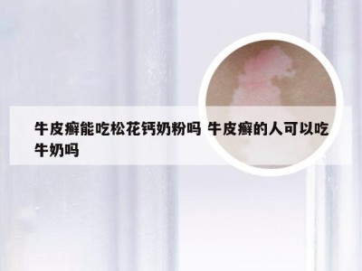 牛皮癣能吃松花钙奶粉吗 牛皮癣的人可以吃牛奶吗