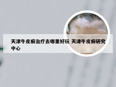天津牛皮癣治疗去哪里好玩 天津牛皮癣研究中心