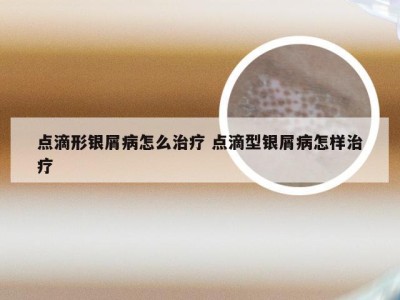 点滴形银屑病怎么治疗 点滴型银屑病怎样治疗