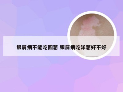 银屑病不能吃圆葱 银屑病吃洋葱好不好