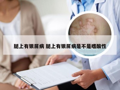 腿上有银屑病 腿上有银屑病是不是嗜酸性