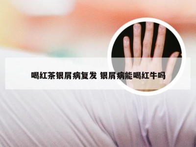 喝红茶银屑病复发 银屑病能喝红牛吗