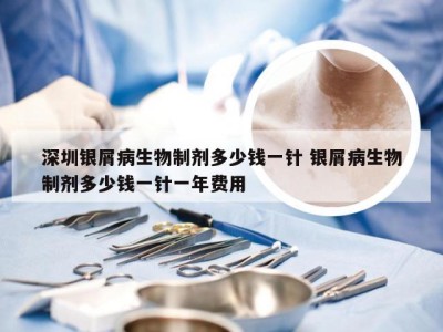 深圳银屑病生物制剂多少钱一针 银屑病生物制剂多少钱一针一年费用