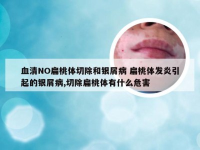 血清NO扁桃体切除和银屑病 扁桃体发炎引起的银屑病,切除扁桃体有什么危害