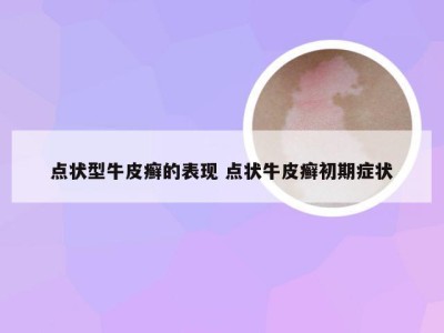 点状型牛皮癣的表现 点状牛皮癣初期症状