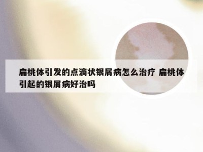 扁桃体引发的点滴状银屑病怎么治疗 扁桃体引起的银屑病好治吗
