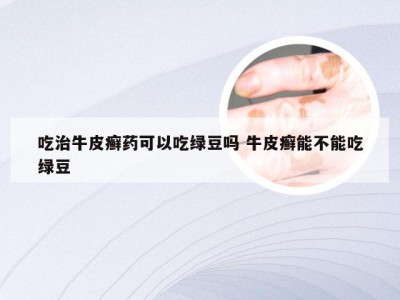 吃治牛皮癣药可以吃绿豆吗 牛皮癣能不能吃绿豆