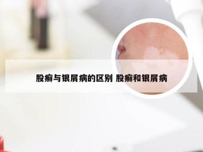 股癣与银屑病的区别 股癣和银屑病