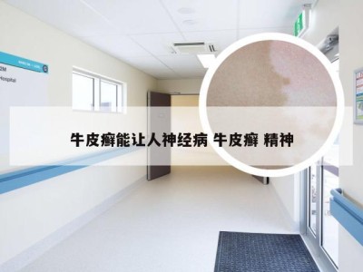 牛皮癣能让人神经病 牛皮癣 精神