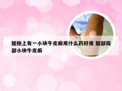 腿挽上有一小块牛皮癣用什么药好用 腿部局部小块牛皮癣