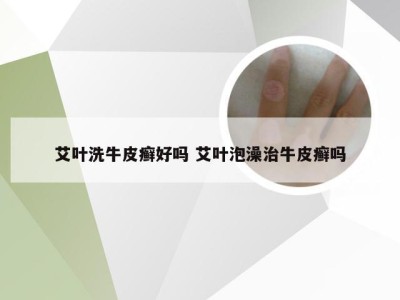 艾叶洗牛皮癣好吗 艾叶泡澡治牛皮癣吗
