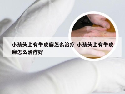 小孩头上有牛皮癣怎么治疗 小孩头上有牛皮癣怎么治疗好