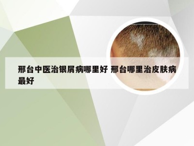 邢台中医治银屑病哪里好 邢台哪里治皮肤病最好