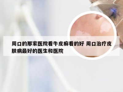 周口的那家医院看牛皮癣看的好 周口治疗皮肤病最好的医生和医院
