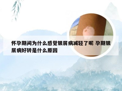 怀孕期间为什么感觉银屑病减轻了呢 孕期银屑病好转是什么原因