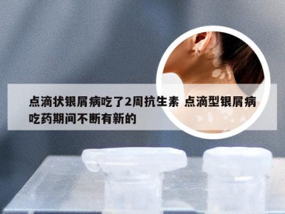 点滴状银屑病吃了2周抗生素 点滴型银屑病吃药期间不断有新的