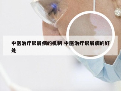 中医治疗银屑病的机制 中医治疗银屑病的好处