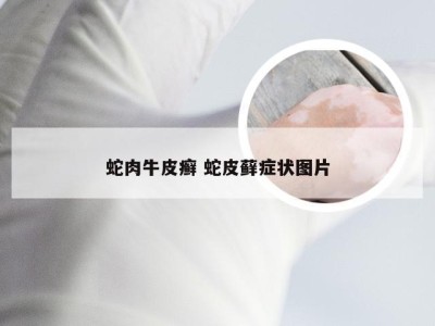 蛇肉牛皮癣 蛇皮藓症状图片