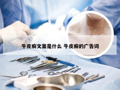牛皮癣文案是什么 牛皮癣的广告词