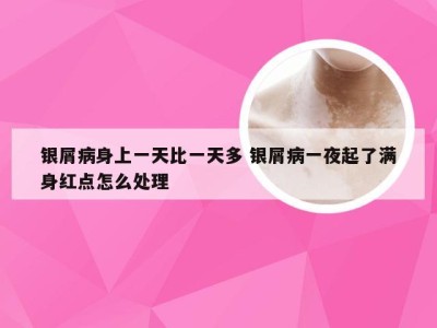银屑病身上一天比一天多 银屑病一夜起了满身红点怎么处理