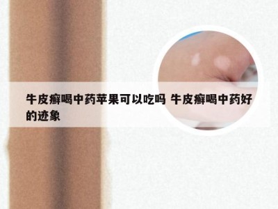 牛皮癣喝中药苹果可以吃吗 牛皮癣喝中药好的迹象