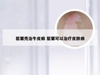 罂粟壳治牛皮癣 罂粟可以治疗皮肤病