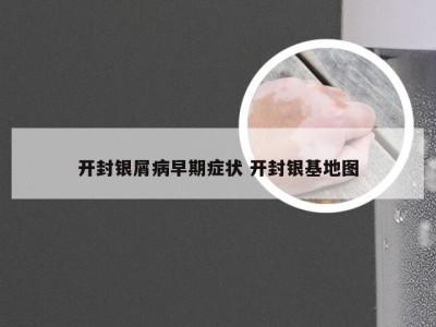 开封银屑病早期症状 开封银基地图