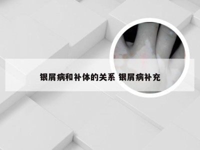 银屑病和补体的关系 银屑病补充