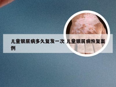 儿童银屑病多久复发一次 儿童银屑病恢复案例