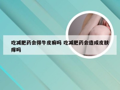 吃减肥药会得牛皮癣吗 吃减肥药会造成皮肤痒吗