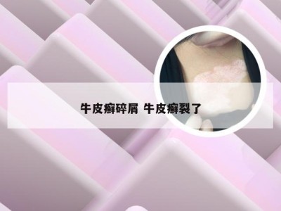 牛皮癣碎屑 牛皮癣裂了