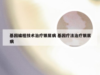 基因编程技术治疗银屑病 基因疗法治疗银屑病