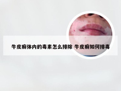 牛皮癣体内的毒素怎么排除 牛皮癣如何排毒
