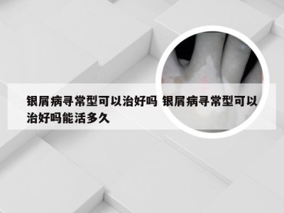 银屑病寻常型可以治好吗 银屑病寻常型可以治好吗能活多久