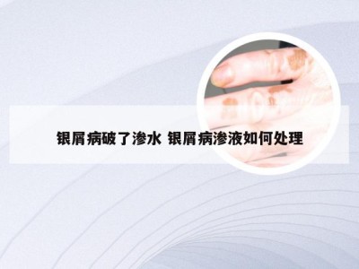 银屑病破了渗水 银屑病渗液如何处理
