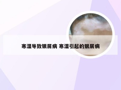 寒湿导致银屑病 寒湿引起的银屑病