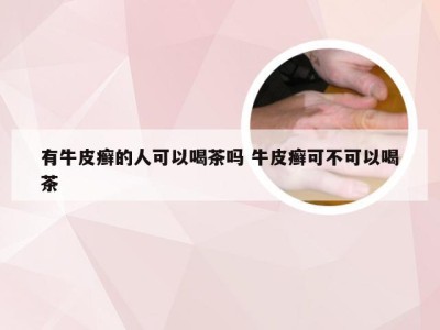有牛皮癣的人可以喝茶吗 牛皮癣可不可以喝茶