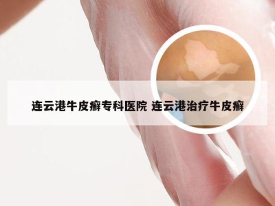 连云港牛皮癣专科医院 连云港治疗牛皮癣