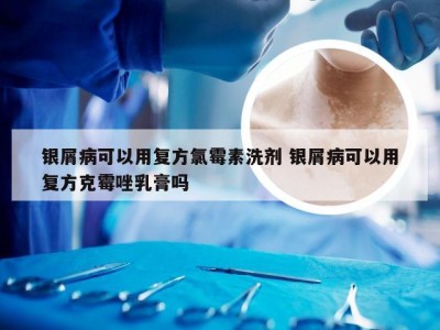 银屑病可以用复方氯霉素洗剂 银屑病可以用复方克霉唑乳膏吗