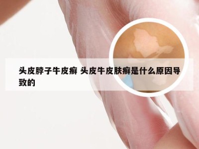 头皮脖子牛皮癣 头皮牛皮肤癣是什么原因导致的