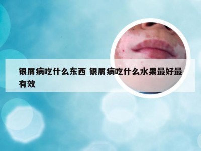 银屑病吃什么东西 银屑病吃什么水果最好最有效