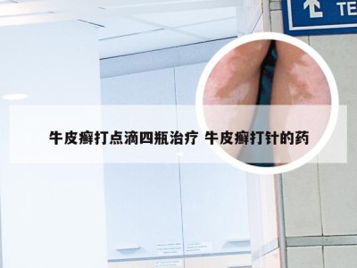 牛皮癣打点滴四瓶治疗 牛皮癣打针的药