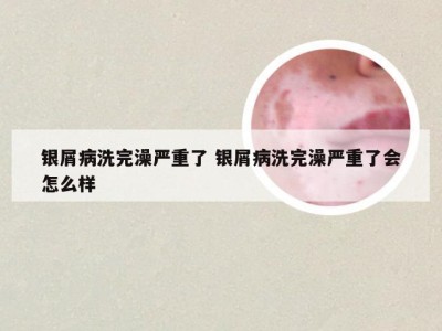 银屑病洗完澡严重了 银屑病洗完澡严重了会怎么样