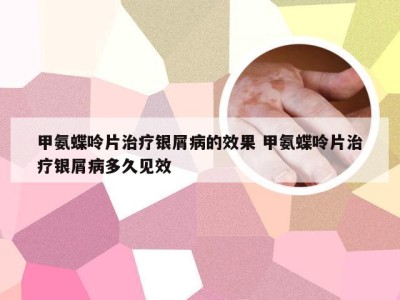 甲氨蝶呤片治疗银屑病的效果 甲氨蝶呤片治疗银屑病多久见效