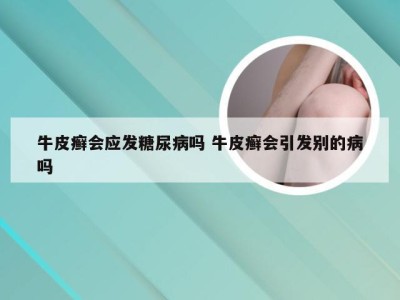 牛皮癣会应发糖尿病吗 牛皮癣会引发别的病吗