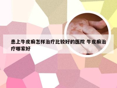 患上牛皮癣怎样治疗比较好的医院 牛皮癣治疗哪家好
