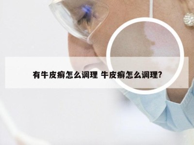 有牛皮癣怎么调理 牛皮癣怎么调理?