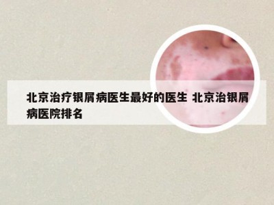 北京治疗银屑病医生最好的医生 北京治银屑病医院排名