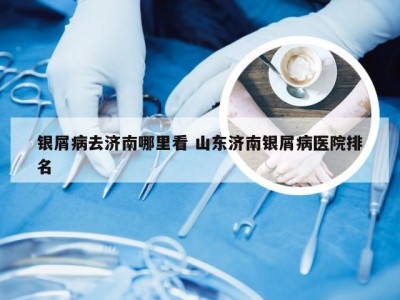 银屑病去济南哪里看 山东济南银屑病医院排名